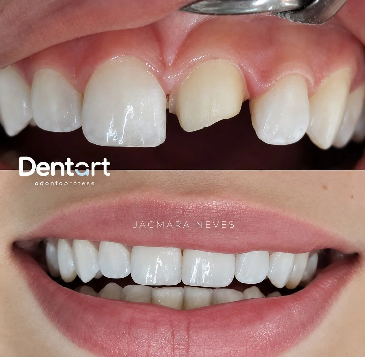 Resultado de tratamento — Instituto Dentart