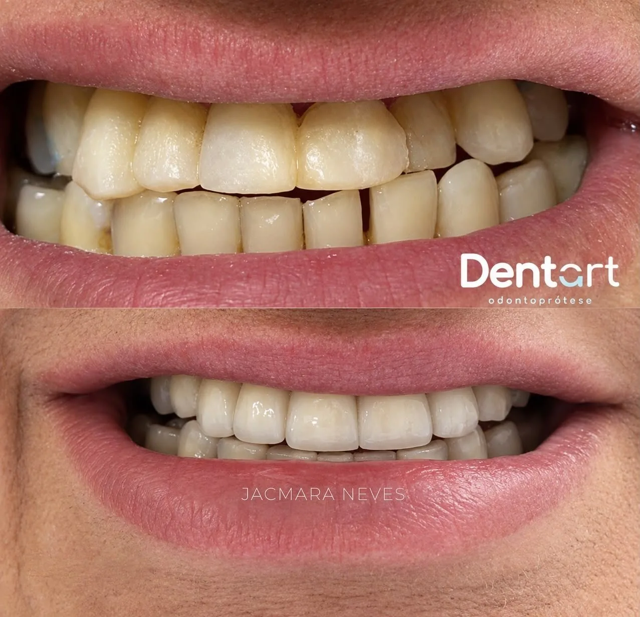 Resultado de tratamento — Instituto Dentart